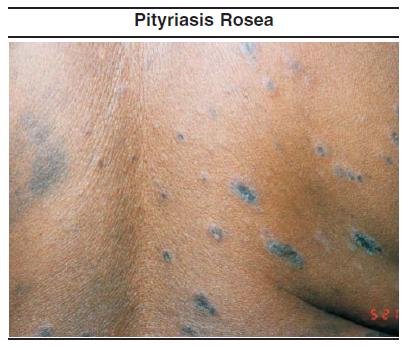 Pityriasis%20Rosea%20Pediatric%20Emergency%20Medicine%20Practice.JPG
