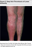 Figure-3-Deep-Vein-Thrombosis-of-Lower-Extremity