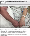Figure-4-Deep-Vein-Thrombosis-of-Upper-Extremity