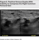 Figure-6-Positive-Venous-Duplex-With-Inability-to-Compress-the-Right-Common-Femoral-Vein