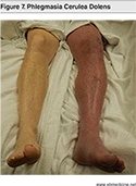 Figure-7-Phlegmasia-Cerulea-Dolens