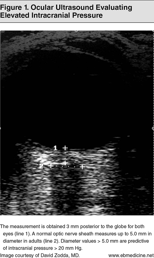 Ocular Ultrasound Evaluating Elevated Intracranial Pressure