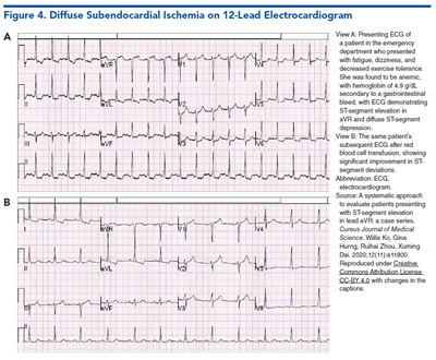 Figure 4. Diffuse Subendocardial Ischemia on 12-Lead Electrocardiogram