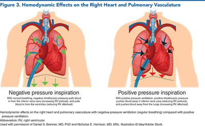 Figure 3. Hemodynamic Effects on the Right Heart and Pulmonary Vasculature