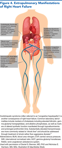 Figure 4. Extrapulmonary Manifestations of Right Heart Failure