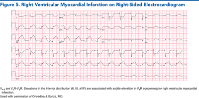 Figure 5. Right Ventricular Myocardial Infarction on Right-Sided Electrocardiogram