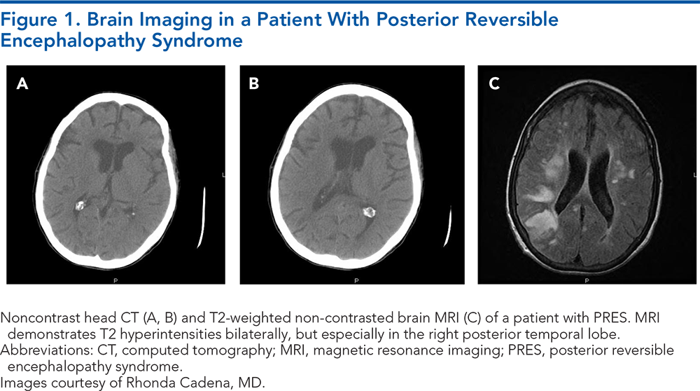 Figure 1. Brain Imaging in a Patient With Posterior Reversible Encephalopathy Syndrome