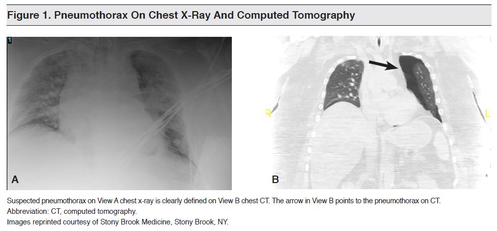 Figure 1. Pneumothorax On Chest X-Ray And Computed Tomography