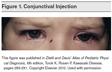 Conjunctival-Injection