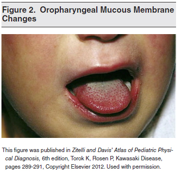 Figure-2-Oropharyngeal-Mucous-Membrane-Changes