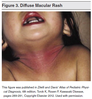 Diffuse-Macular-Rash