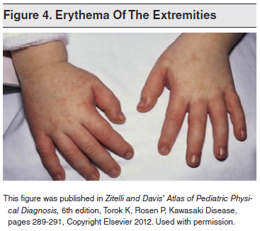 Erythema-Of-The-Extremities