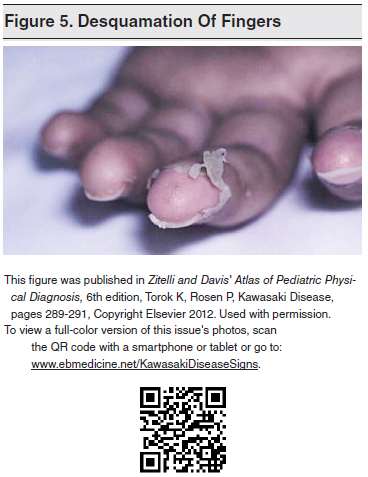 Desquamation-Of-Fingers