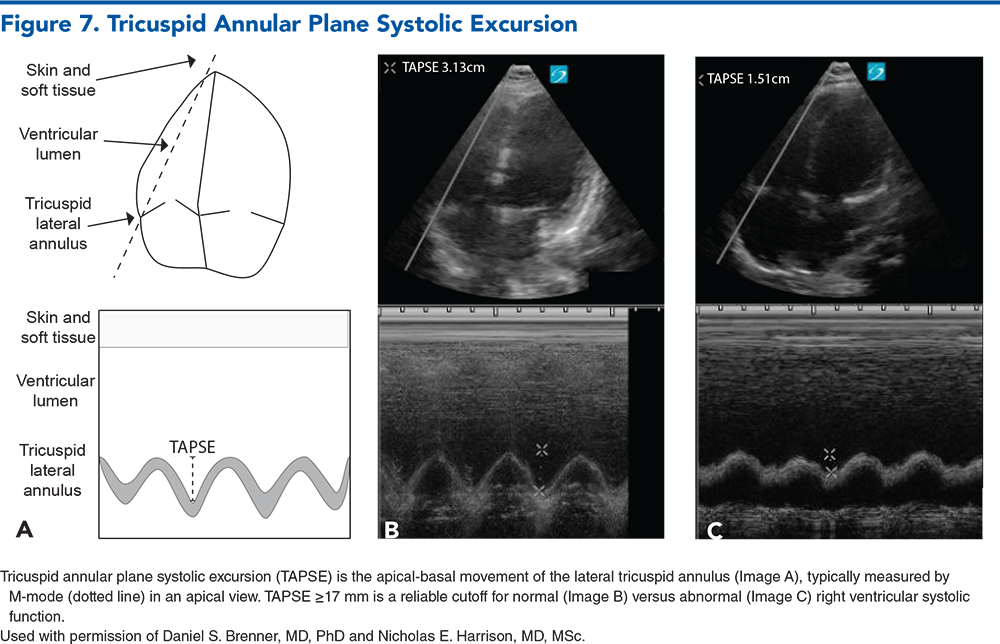 Figure 7. Tricuspid Annular Plane Systolic Excursion