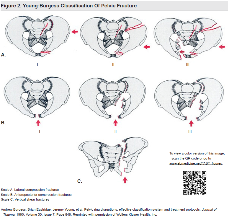 Figure 2_ Young-Burgess Classification Of Pelvic Fracture