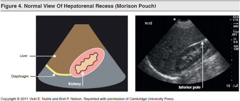 Figure 4_ Normal View Of Hepatorenal Recess (Morison Pouch)