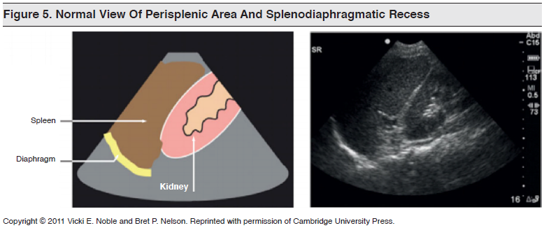 Figure 5_ Normal View Of Perisplenic Area And Splenodiaphragmatic Recess