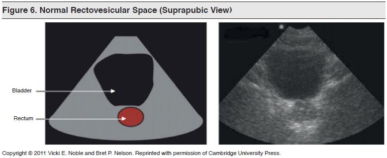 Figure 6_ Normal Rectovesicular Space (Suprapubic View)