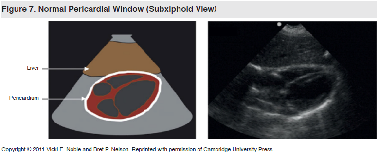 Figure 7_ Normal Pericardial Window (Subxiphoid View)