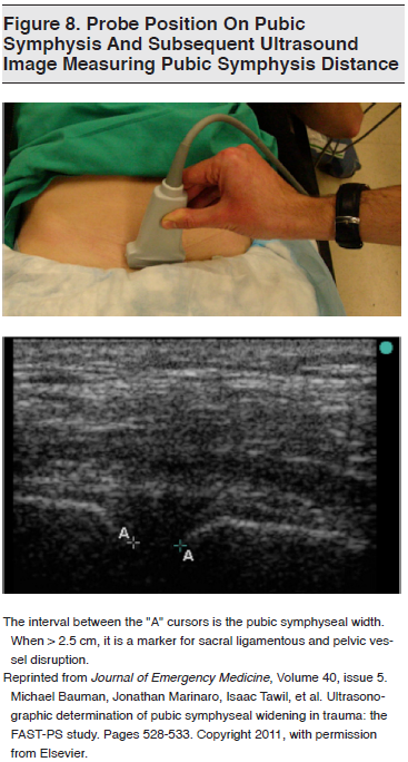 Figure 8_ Probe Position On Pubic Symphysis And Subsequent Ultrasound Image Measuring Pubic Symphysis Distance