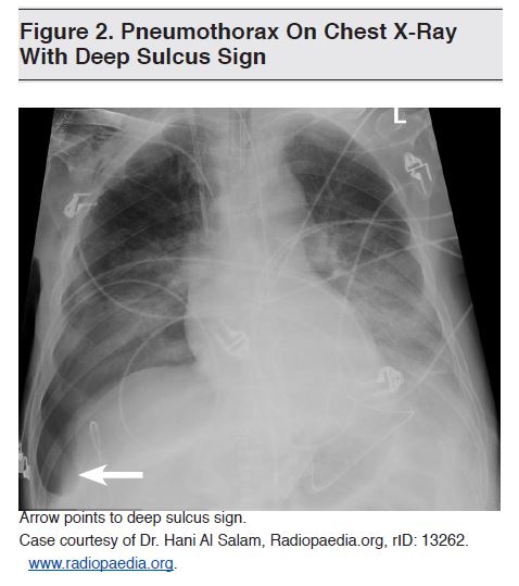 Figure 2. Pneumothorax On Chest X-Ray With Deep Sulcus Sign