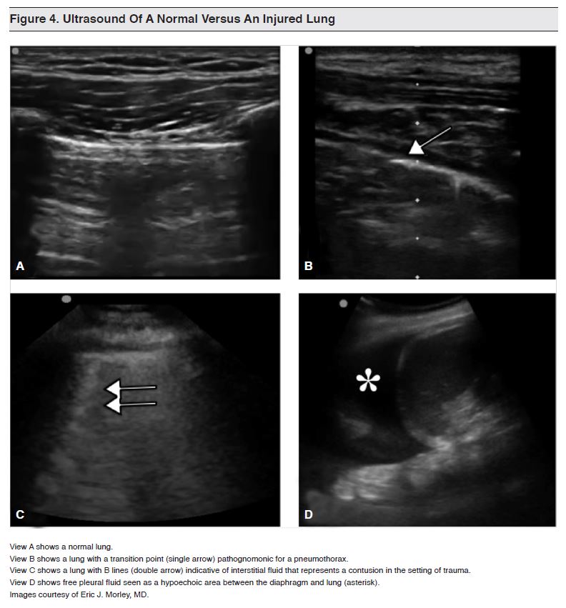Figure 4. Ultrasound Of A Normal Versus An Injured Lung