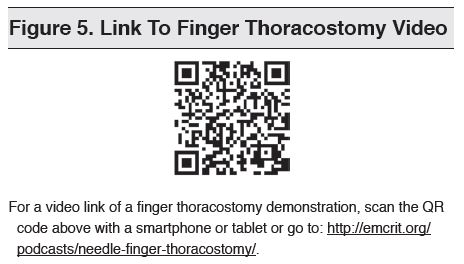 Figure 5. Link To Finger Thoracostomy Video