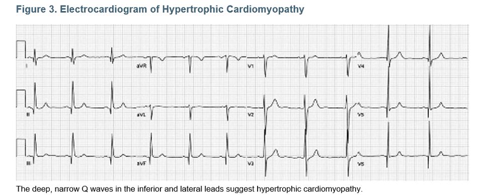 Figure 3. Electrocardiogram of Hypertrophic Cardiomyopathy