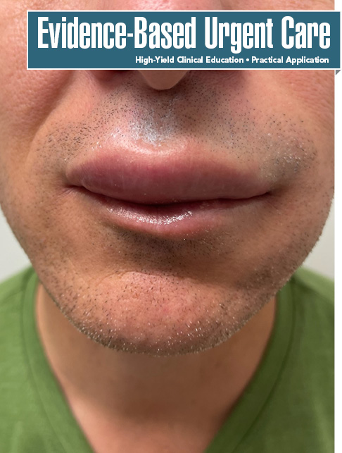 Evidence-Based Management of Angioedema in Urgent Care (Pharmacology CME)
