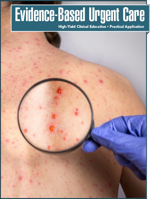 Identification and Treatment of Drug-Induced Skin Reactions for the Urgent Care Clinician (Pharmacology CME)