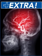 Emergency Department Diagnosis and Management of Cerebral Venous Sinus Thrombosis - Stroke EXTRA Supplement (Stroke CME)
