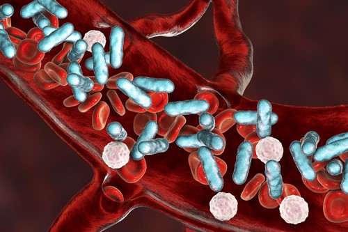 Sepsis And Septic Shock: The Sofa Score (Qsofa) And Treatments Sepsis And Septic Shock: The Sofa Score (Qsofa) And Treatments