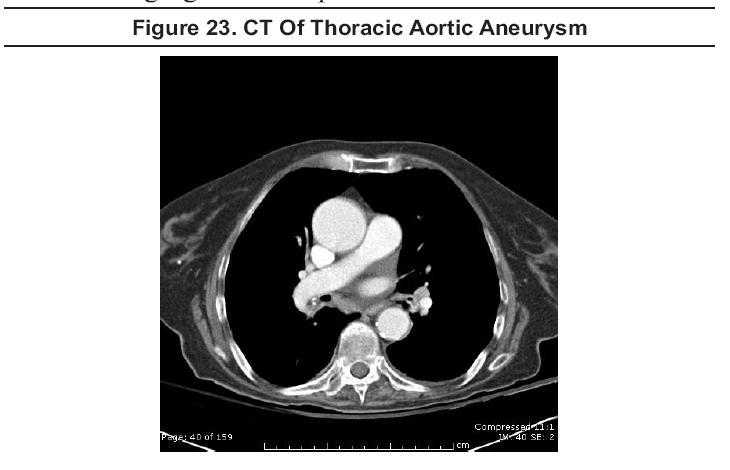 CT Of Thoracic Aortic Aneurysm