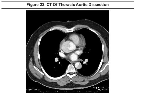CT Of Thoracic Aortic Dissection