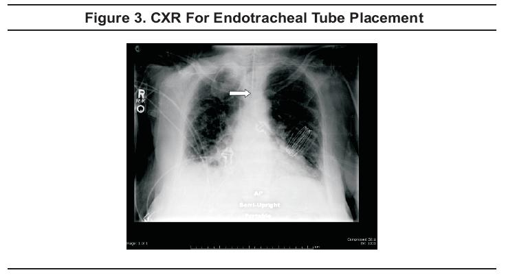 CXR For Endotracheal Tube Placement