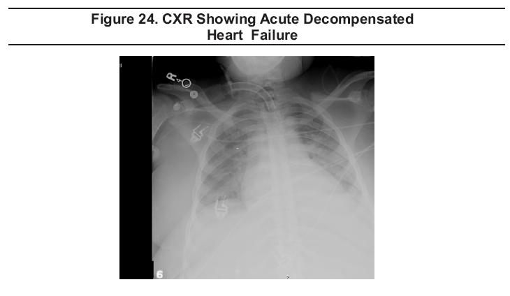 CXR Showing Acute Decompensated Heart Failure