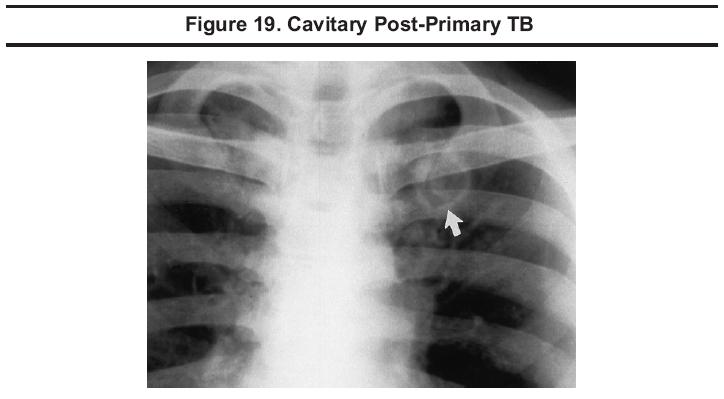 Cavitary Post Primary TB