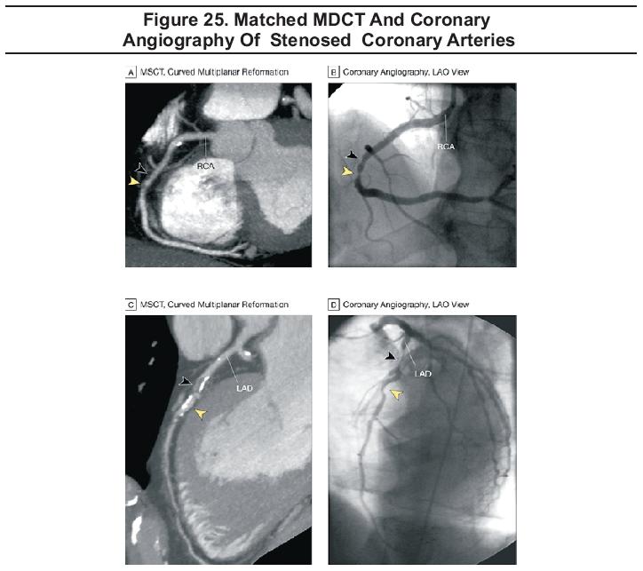 Matched MDCT And Coronary Angiography Of Stenosed Coronary Arteries