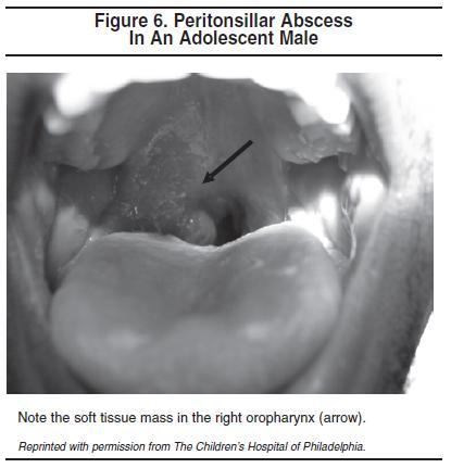 Complications Of Peritonsillar Infections Include Airway Obstruction 
