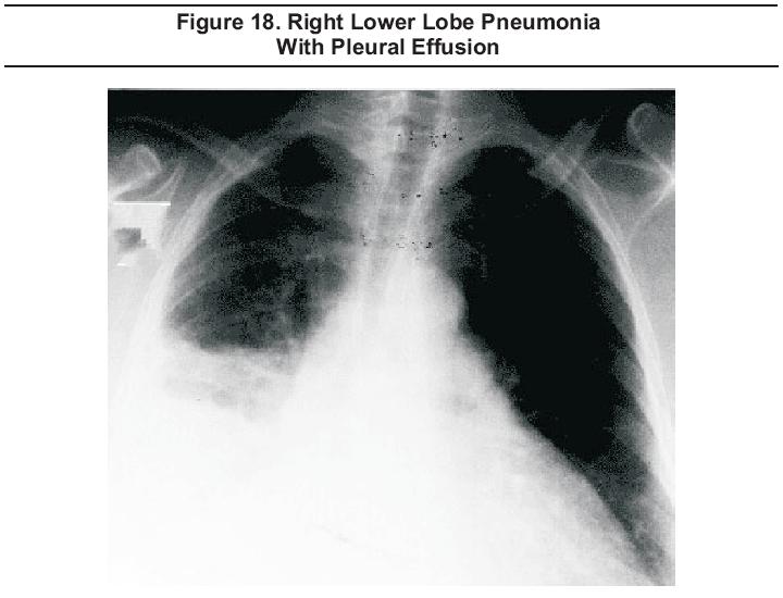 Right Lower Lobe Pneumonia With Pleural Effusion